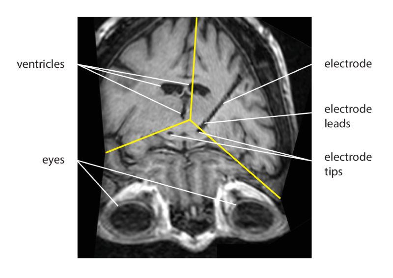 안구와 뇌실을 기준으로 전극 배치를 보여주는 환자의 뇌 MRI 영상.