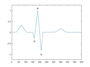Figure 2.  A QRS complex from an ECG signal.
