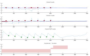 Figure 3. Two ECG signals and one PPG signal showing asystole. Votes are accumulated in the result vector R, with positive values reflecting agreement that no heartbeats are present