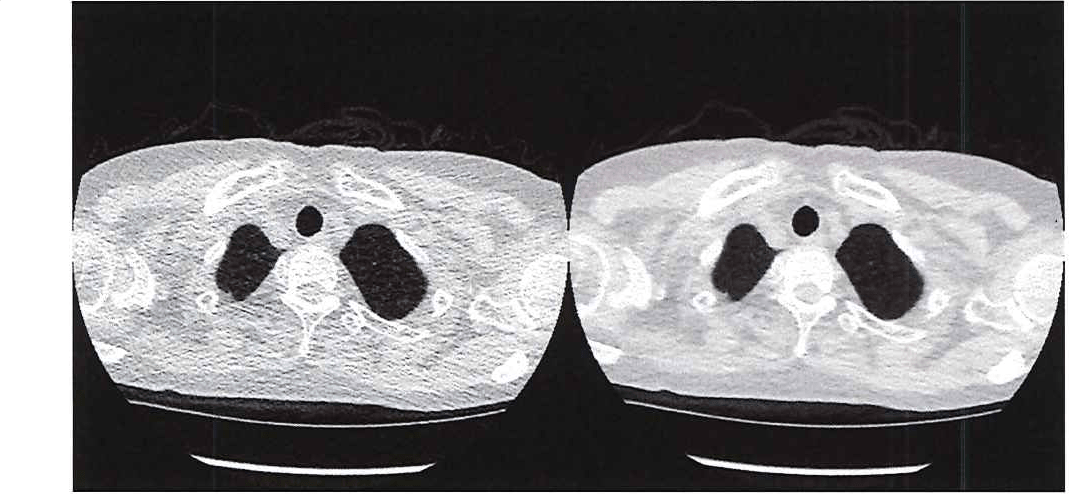 그림 1. 초저선량 CT(왼쪽)와 기존 CT(오른쪽)의 이미지 품질 비교.