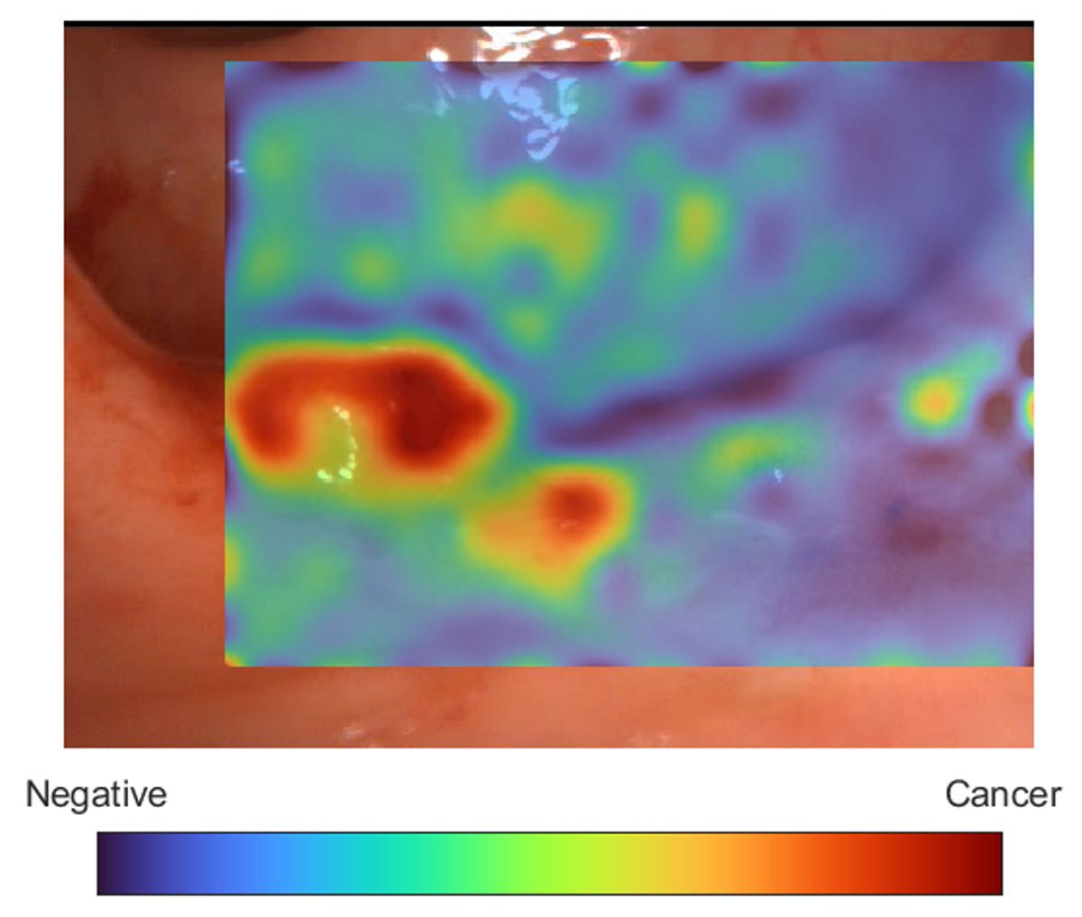 대장 용종 이미지에 색상이 적용된 오버레이가 표시되어 AI가 예측한 영역이 암인지 비암인지의 확률이 표시됩니다.