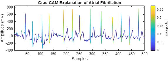ECG waveform with overlaid Grad‑CAM importance scores highlighting which segments the model considers important for identifying atrial fibrillation.