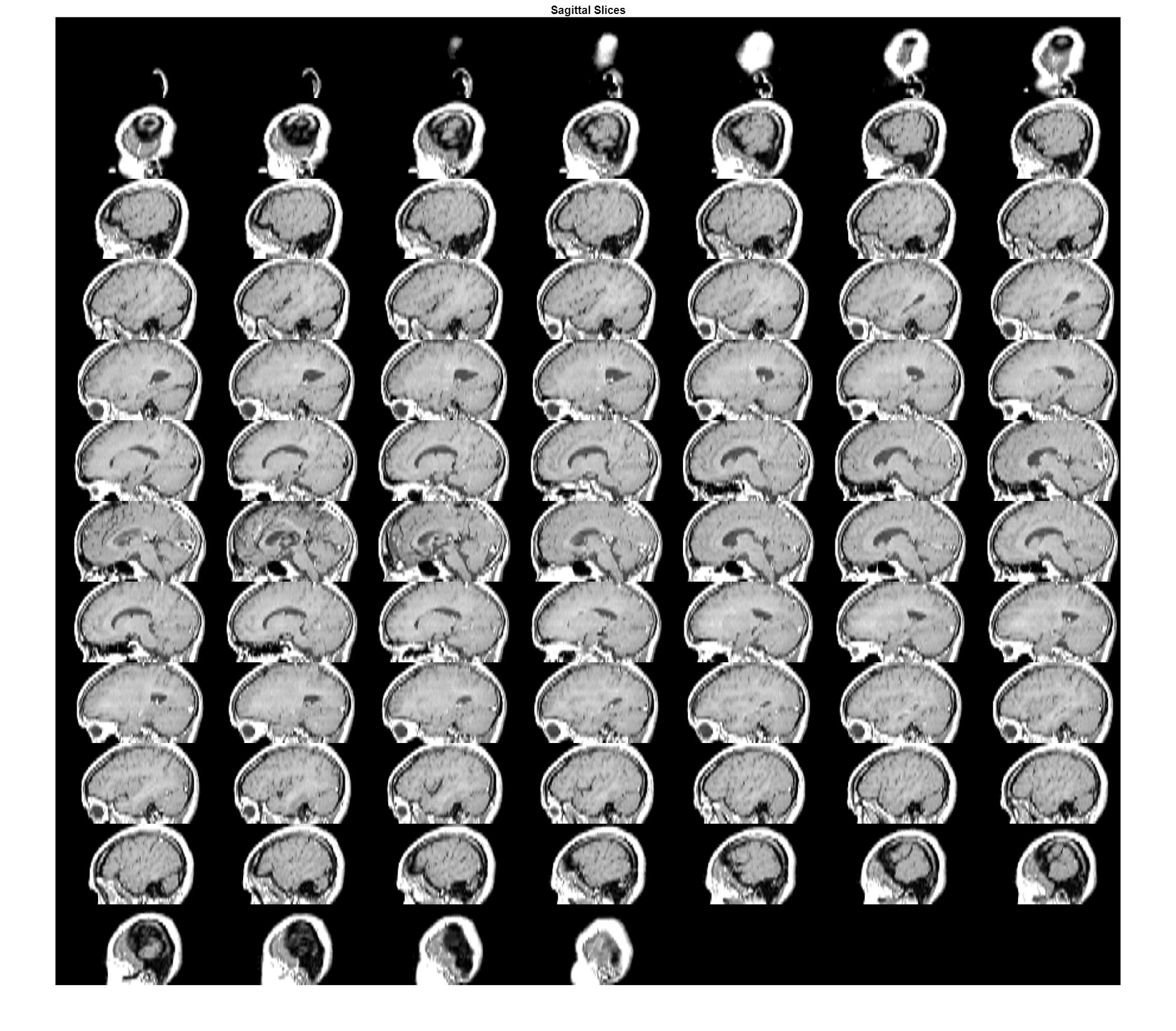 Figure contains an axes object. The axes object with title Sagittal Slices contains an object of type image.