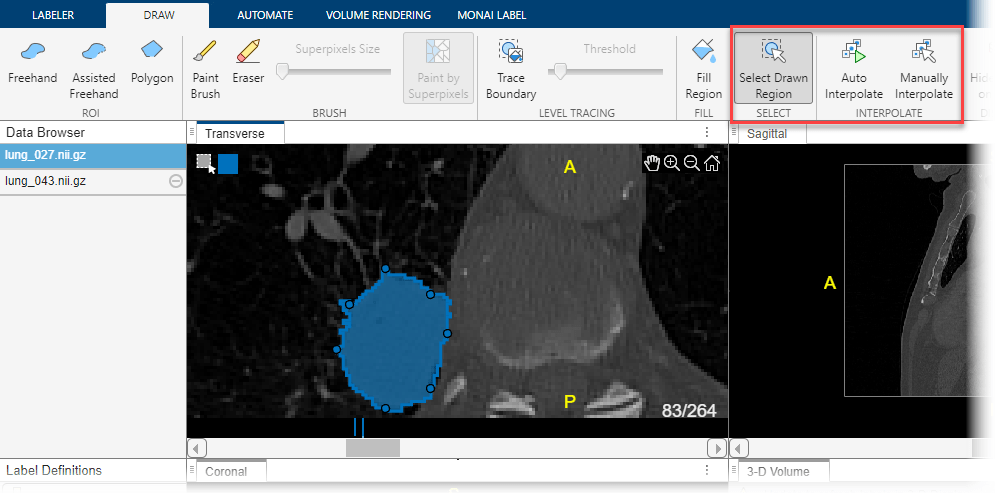 Lung tumor label drawn using the paint by superpixels tool