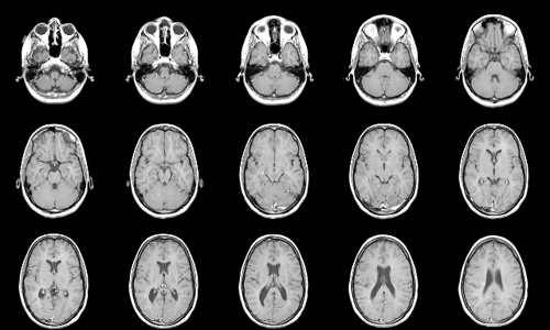 Fifteen axial slices of a brain MRI.