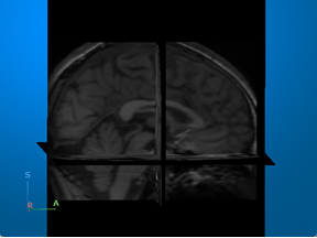 MRI volume displayed as anatomical slice planes using the volshow function