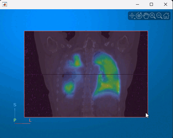 Animation of a multimodal CT and PET display created using volshow. The animation scrolls through slices in the coronal plane.