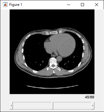 Browse slices of a medical volume using a sliceViewer object
